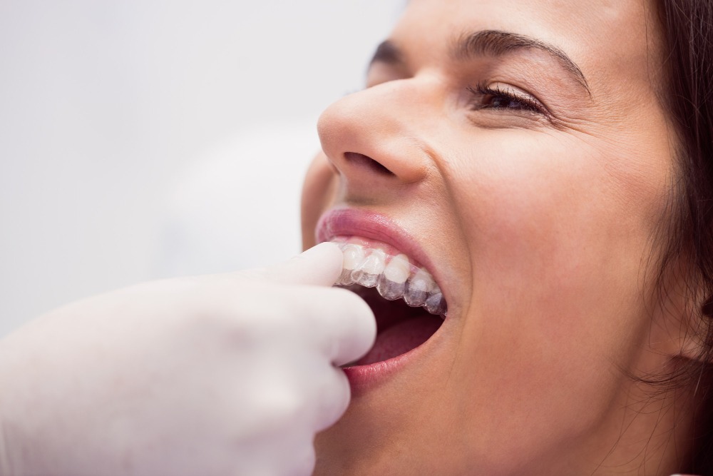 Top Benefits of Choosing Invisalign Treatment in Dubai